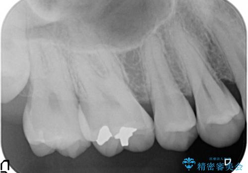 水銀を含む環境汚染金属アマルガムの除去 奥歯のセラミックインレー修復の治療前