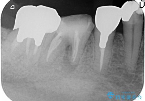 5根管(近心に3根管)を持つ下顎第1大臼歯へのイニシャルトリートメントの治療後