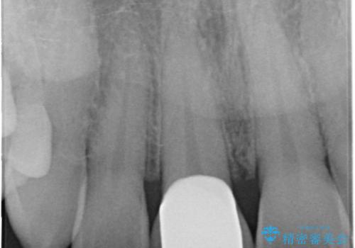 前歯の破折→オールセラミックによる審美性の回復の治療後