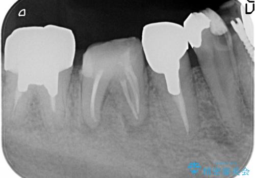 5根管(近心に3根管)を持つ下顎第1大臼歯へのイニシャルトリートメントの治療後