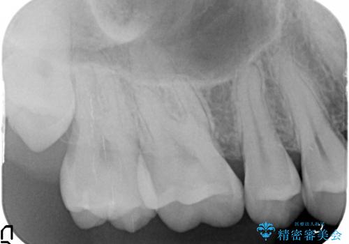 水銀を含む環境汚染金属アマルガムの除去 奥歯のセラミックインレー修復の治療後