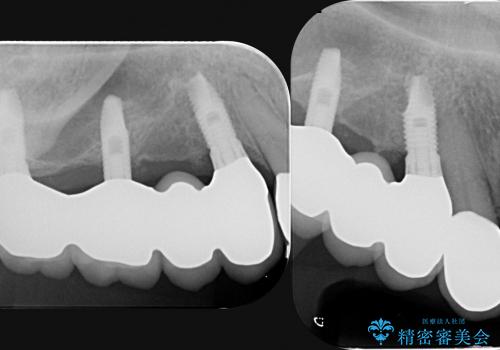 [歯周病治療] インプラント・ブリッジによる咬合機能回復の治療後