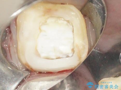 5根管(近心に3根管)を持つ下顎第1大臼歯へのイニシャルトリートメントの治療中