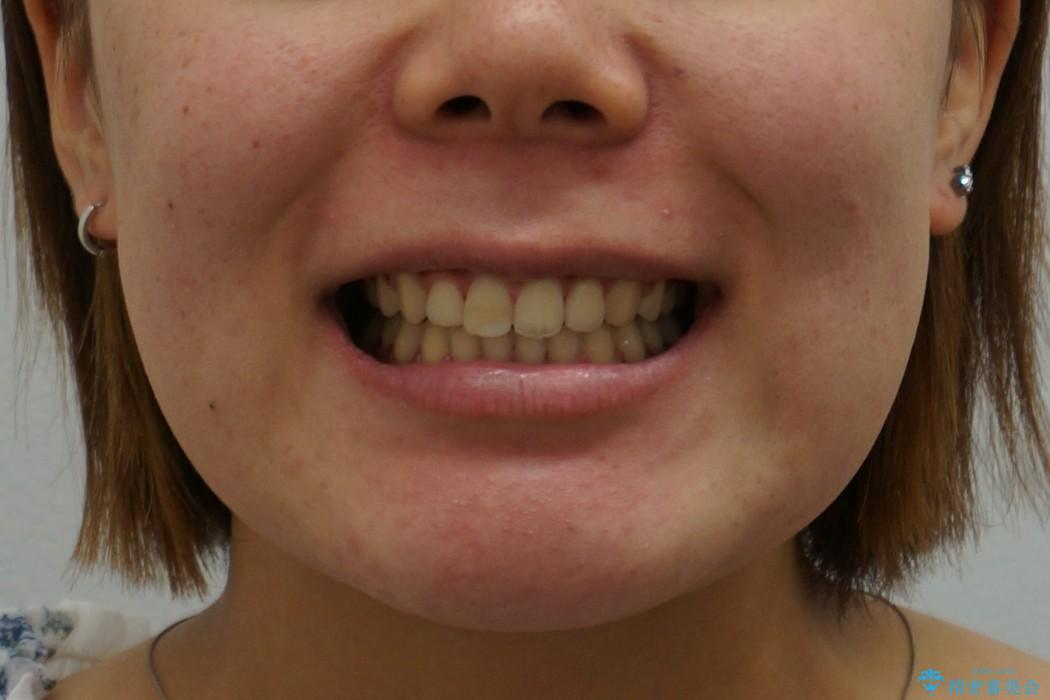 抜かない矯正　すきっ歯　前歯が欠けた　右上奥歯を後ろに下げて治療の治療後（顔貌）