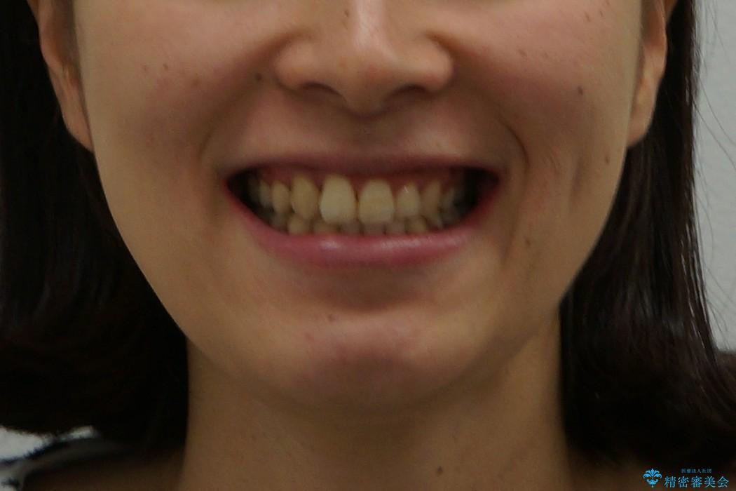 歯周病と矯正治療　一歩踏み込んだ予防治療ですの治療後（顔貌）
