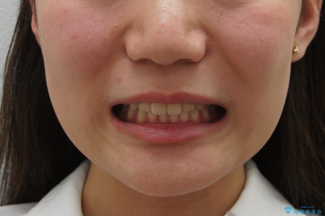 手軽なマウスピース矯正　インビザラインライト　前歯のねじれの治療後（顔貌）
