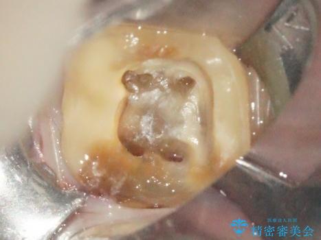 5根管(近心に3根管)を持つ下顎第1大臼歯へのイニシャルトリートメントの治療中
