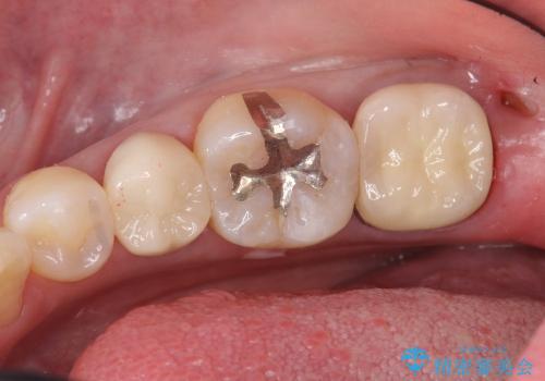 銀歯を白く　セラミックインレー修復の治療前