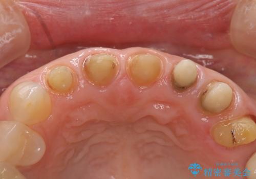 歯の根元が黒いのが気になる　セラミックによる再補綴での改善の治療中