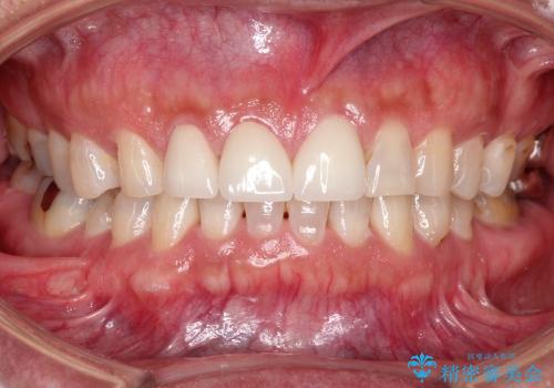 前歯の隙間を改善(オールセラミッククラウン)の治療後
