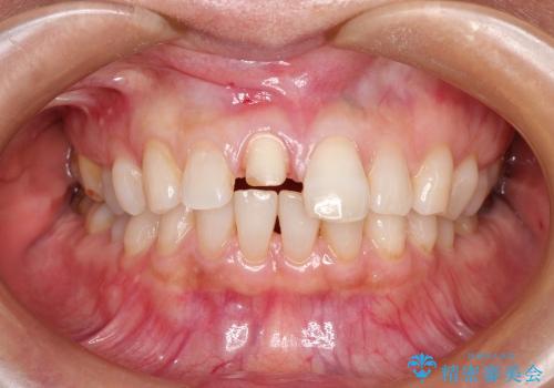 前歯の破折→オールセラミックによる審美性の回復の治療中