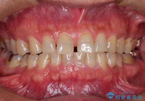 前歯の隙間を改善(オールセラミッククラウン)の治療前