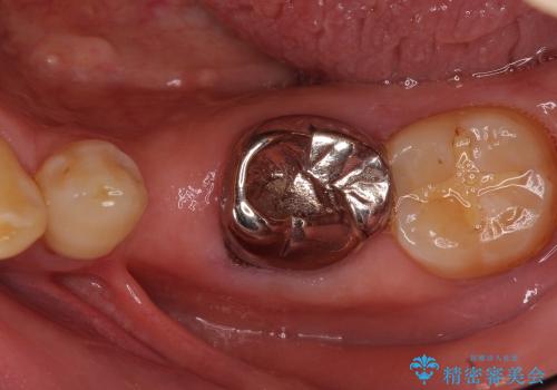 セラミックブリッジによる奥歯の短期間治療の治療前