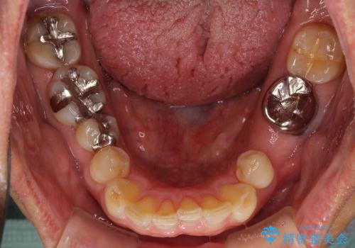 セラミックブリッジによる奥歯の短期間治療の治療前