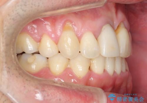 前歯の劇的な変化　前歯の著しいガタつき、変色の治療後