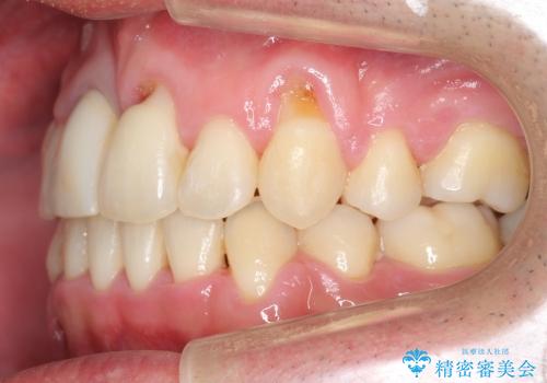 前歯の劇的な変化　前歯の著しいガタつき、変色の治療後
