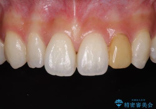 小さい歯をきれいにしたい　矮小歯のセラミック治療