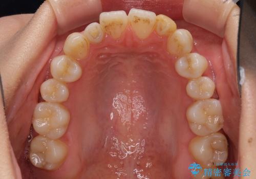 小さい歯をきれいにしたい　矮小歯のセラミック治療の治療前