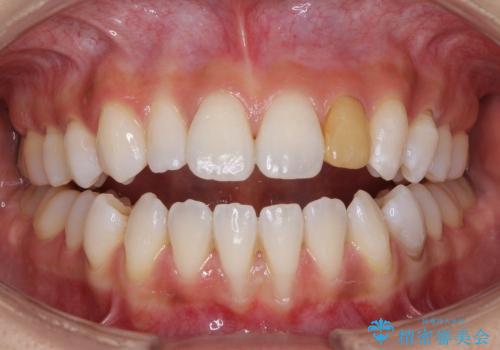 小さい歯をきれいにしたい　矮小歯のセラミック治療の治療後