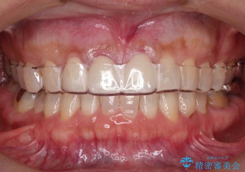 前歯の隙間を改善(オールセラミッククラウン)の治療後