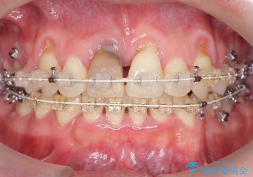 前歯の劇的な変化　前歯の著しいガタつき、変色の治療中