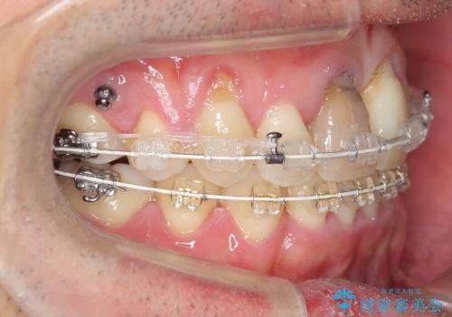 前歯の劇的な変化　前歯の著しいガタつき、変色の治療中