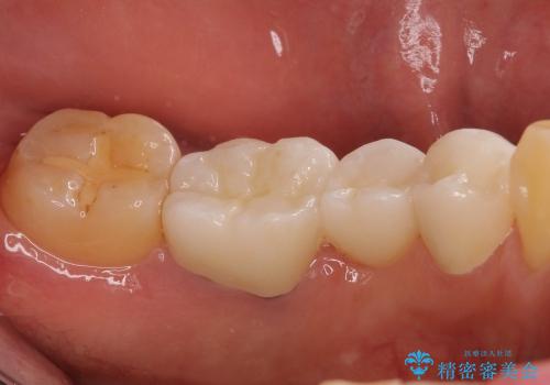 セラミックブリッジによる奥歯の短期間治療の治療後