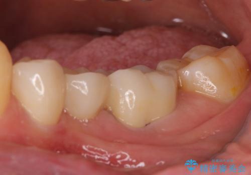 セラミックブリッジによる奥歯の短期間治療