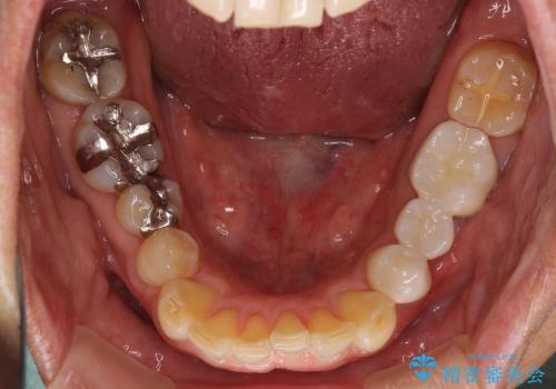 セラミックブリッジによる奥歯の短期間治療の治療後