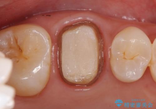 銀歯を白いきれいな歯への治療中