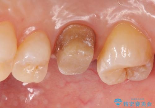 銀歯を白いきれいな歯への治療中