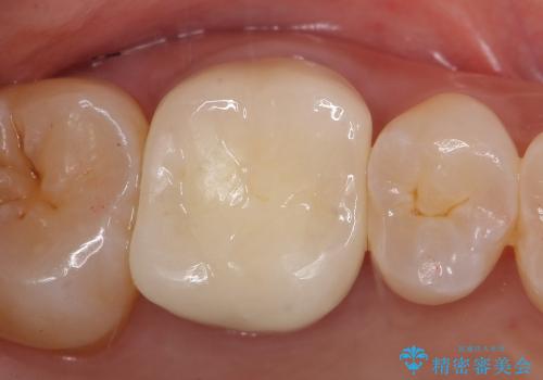 銀歯を白いきれいな歯への治療後