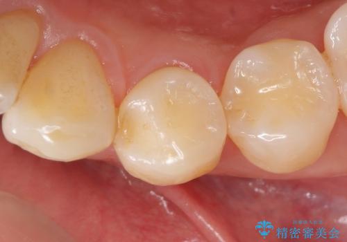 セラミックインレーによる早期虫歯治療の治療前