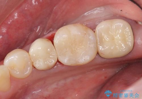 銀歯を白く　セラミックインレー修復の治療後