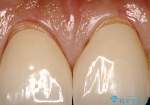 前歯の隙間を改善(オールセラミッククラウン)の治療前