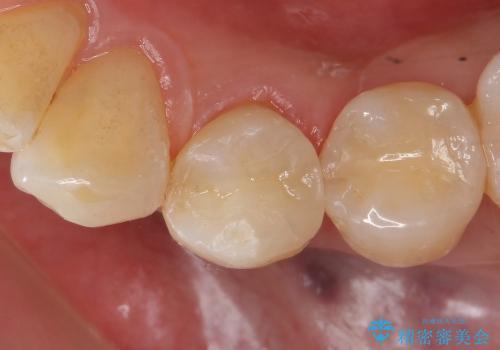 セラミックインレーによる早期虫歯治療の治療後