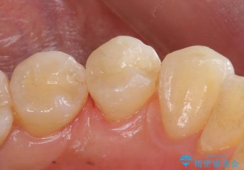 セラミックインレーによる早期虫歯治療の治療後