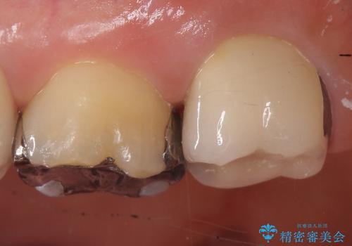 強く痛む歯の根管治療および補綴治療の治療後