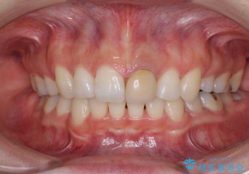 気になる口元をきれいに　前歯と奥歯のセラミック治療の治療前