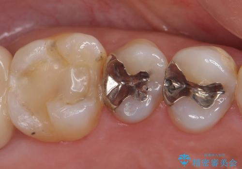 古い銀歯やプラスチックをセラミックへの症例 治療前