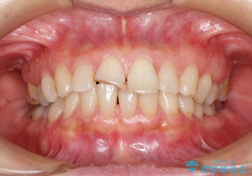 前歯の破折→オールセラミックによる審美性の回復の治療前