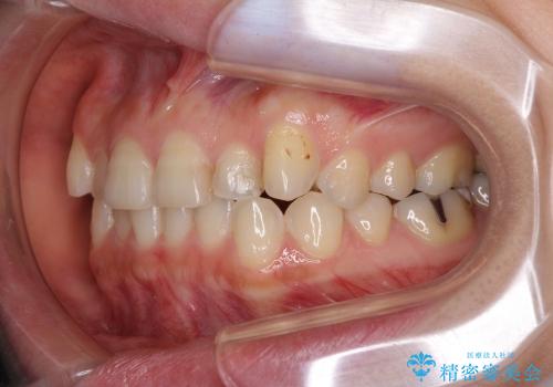 インビザラインによる前歯のでこぼこ改善の治療前
