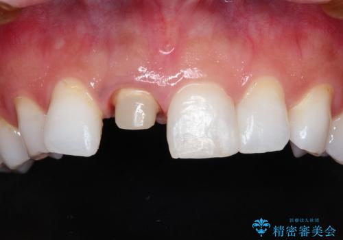 前歯の破折→前歯のセラミック治療(土台ごとやり変え)の治療中