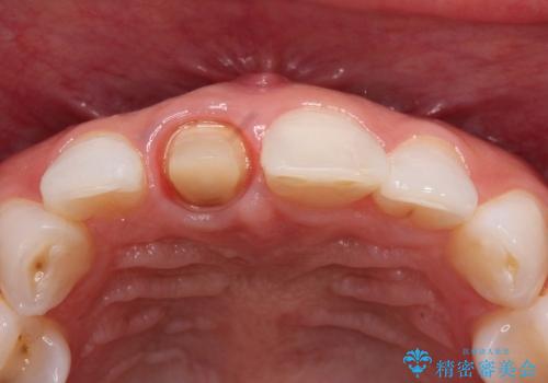 前歯の破折→前歯のセラミック治療(土台ごとやり変え)の治療中