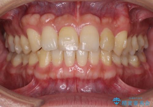 前歯の軽度のでこぼこをインビザライン　ライトで改善の治療中