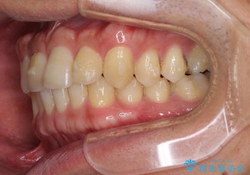 前歯の軽度のでこぼこをインビザライン　ライトで改善の治療中
