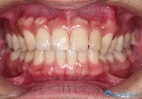 前歯の軽度のでこぼこをインビザライン　ライトで改善の治療前