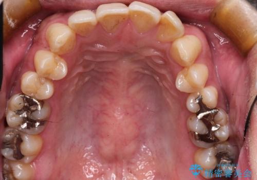 前歯の軽度のでこぼこをインビザライン　ライトで改善の症例 治療前