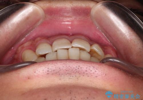 前歯の軽度のでこぼこをインビザライン　ライトで改善の治療前