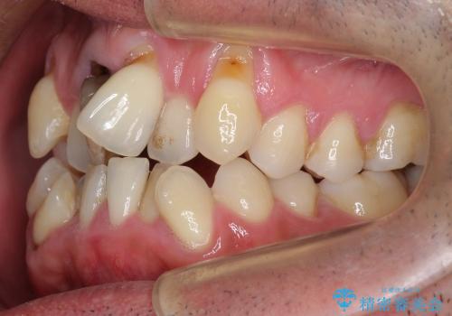 前歯の劇的な変化　前歯の著しいガタつき、変色の治療前